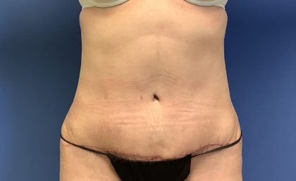 Tummy Tuck Before & After Patient #2774