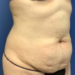 Tummy Tuck Before & After Patient #2774