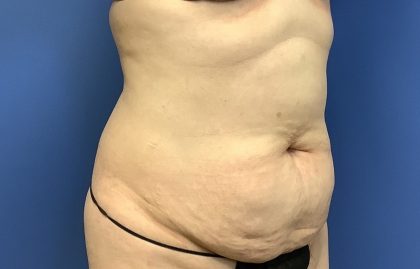 Tummy Tuck Before & After Patient #2774