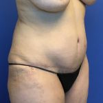 Tummy Tuck Before & After Patient #2779