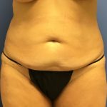 Tummy Tuck Before & After Patient #2779