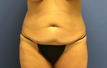 Tummy Tuck Before & After Patient #2779