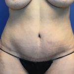 Tummy Tuck Before & After Patient #2779
