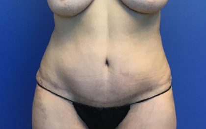 Tummy Tuck Before & After Patient #2779