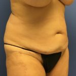Tummy Tuck Before & After Patient #2779