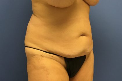 Tummy Tuck Before & After Patient #2779