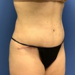 Tummy Tuck Before & After Patient #2784