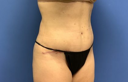 Tummy Tuck Before & After Patient #2784