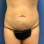 Tummy Tuck Before & After Patient #2784