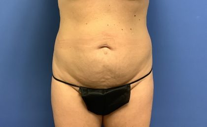 Tummy Tuck Before & After Patient #2784