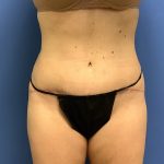 Tummy Tuck Before & After Patient #2784