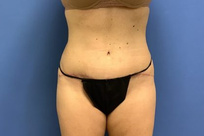 Tummy Tuck Before & After Patient #2784