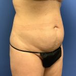 Tummy Tuck Before & After Patient #2784