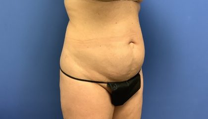 Tummy Tuck Before & After Patient #2784