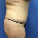 Tummy Tuck Before & After Patient #2789