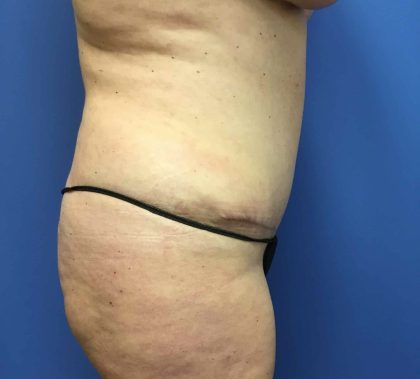Tummy Tuck Before & After Patient #2789