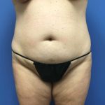 Tummy Tuck Before & After Patient #2789