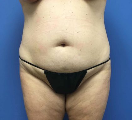 Tummy Tuck Before & After Patient #2789