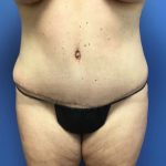 Tummy Tuck Before & After Patient #2789