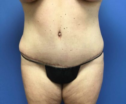 Tummy Tuck Before & After Patient #2789
