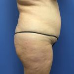 Tummy Tuck Before & After Patient #2789