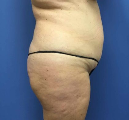 Tummy Tuck Before & After Patient #2789