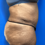 Tummy Tuck Before & After Patient #2794