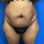 Tummy Tuck Before & After Patient #2794