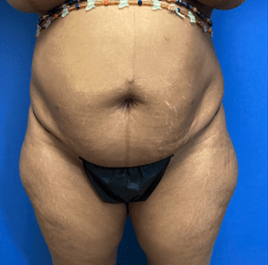 Tummy Tuck Before & After Patient #2794