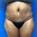 Tummy Tuck Before & After Patient #2794