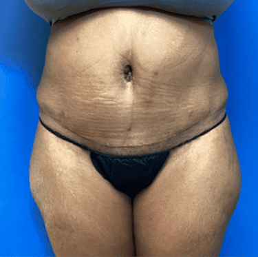 Tummy Tuck Before & After Patient #2794