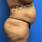 Tummy Tuck Before & After Patient #2794