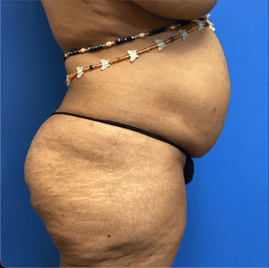 Tummy Tuck Before & After Patient #2794