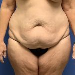 Tummy Tuck Before & After Patient #2799