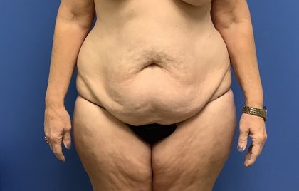 Tummy Tuck Before & After Patient #2799