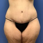 Tummy Tuck Before & After Patient #2799