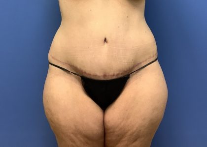 Tummy Tuck Before & After Patient #2799