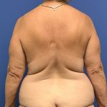 Tummy Tuck Before & After Patient #2799