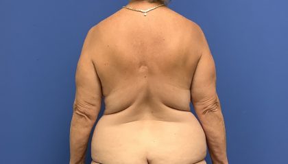Tummy Tuck Before & After Patient #2799
