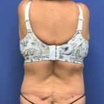 Tummy Tuck Before & After Patient #2804