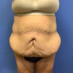 Tummy Tuck Before & After Patient #2804