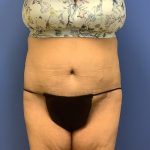 Tummy Tuck Before & After Patient #2804