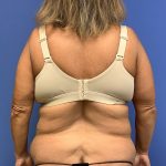 Tummy Tuck Before & After Patient #2804