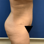 Tummy Tuck Before & After Patient #2809