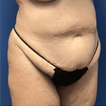 Tummy Tuck Before & After Patient #2809