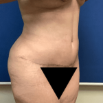 Tummy Tuck Before & After Patient #2809