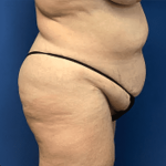 Tummy Tuck Before & After Patient #2809