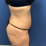 Tummy Tuck Before & After Patient #2814