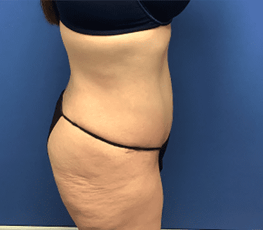 Tummy Tuck Before & After Patient #2814