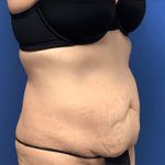 Tummy Tuck Before & After Patient #2814